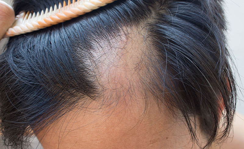 Tratamiento láser alopecia