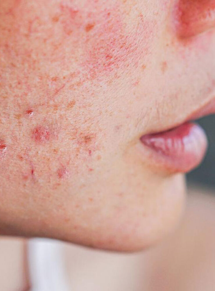 Cicatrices acné