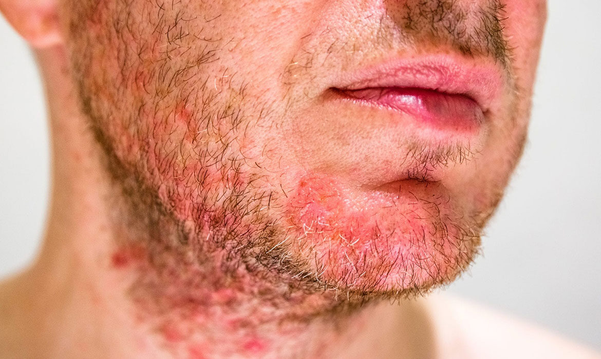 Dermatitis seborreica: ¿cómo tratarla? - Top Farma