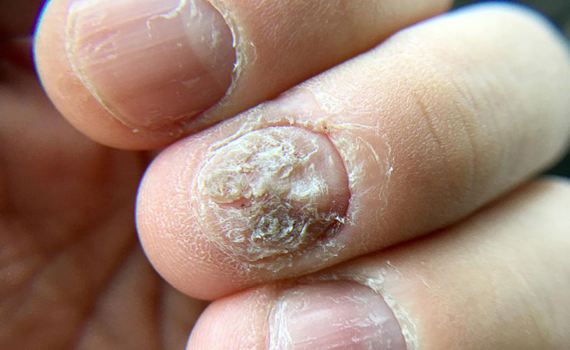 Tratamiento hongos en las uñas