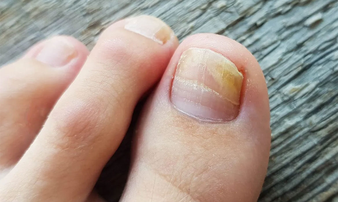 Alerta podológica Los esmaltes permanentes pueden causar hongos en las uñas  de los pies  Actualidad  Cadena SER